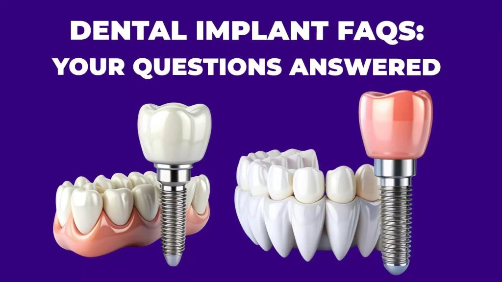 faqs about dental implants