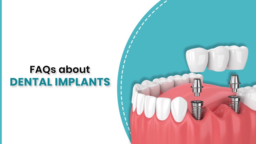 faqs about dental implants
