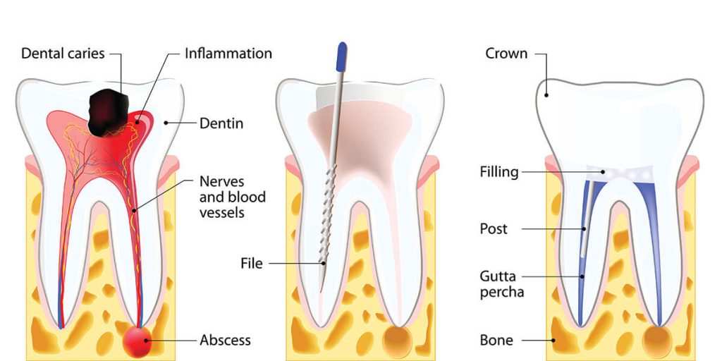 Need a Root Canal Treatment