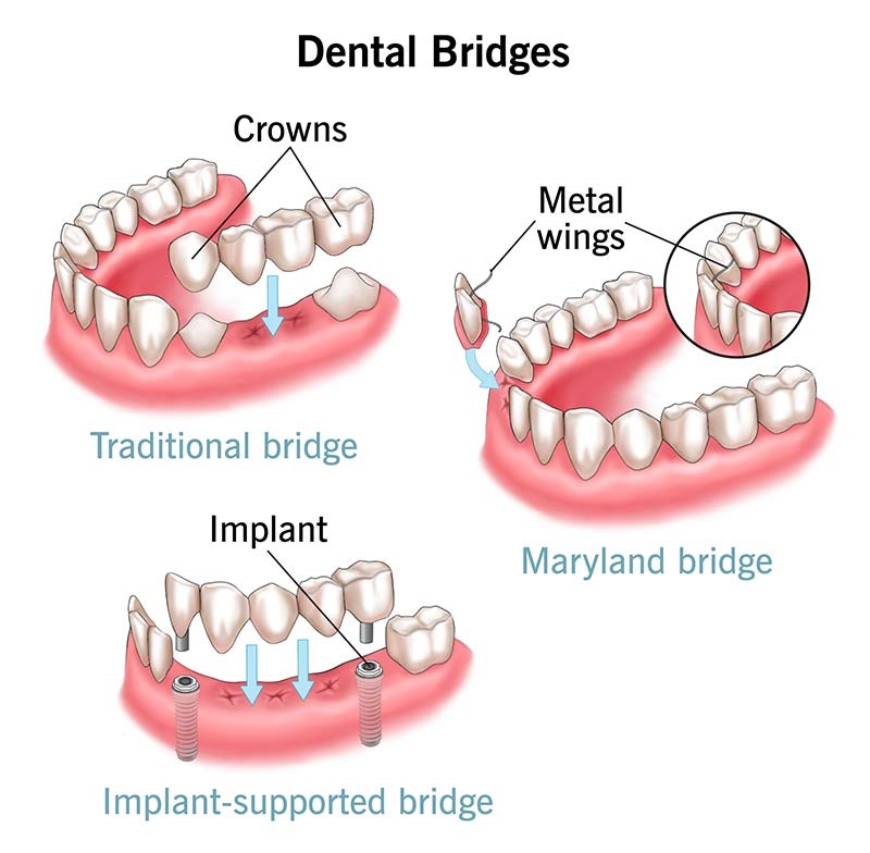 Dental Bridge Procedure