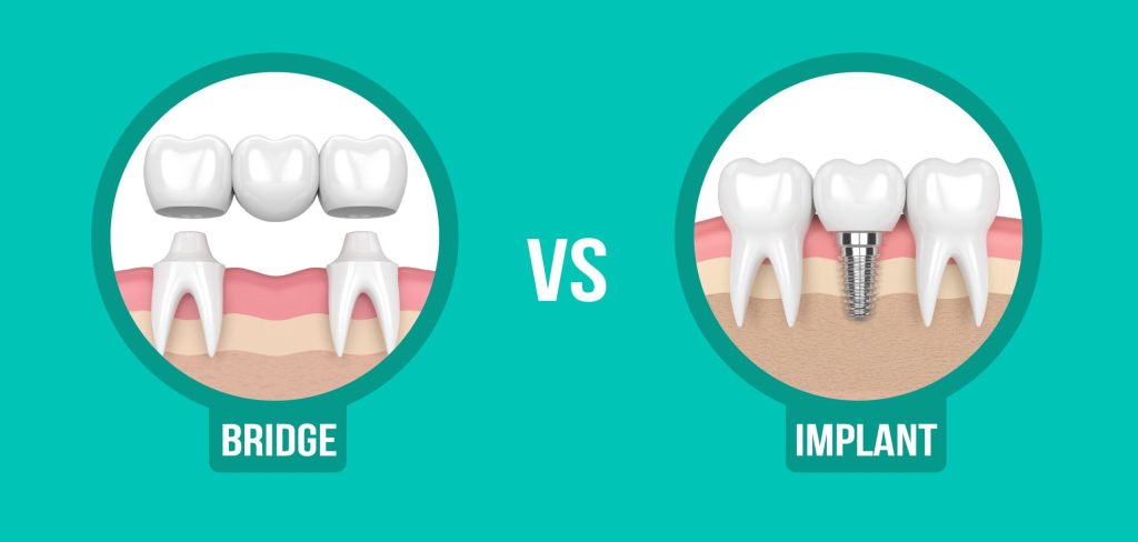 Difference Between Dental Implant and Bridge