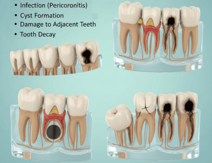 Wisdom Tooth Extraction
