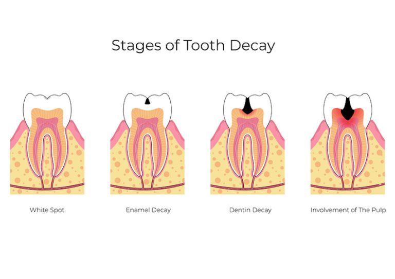 Top 10 Frequently Asked Questions (FAQs) on Tooth Decay