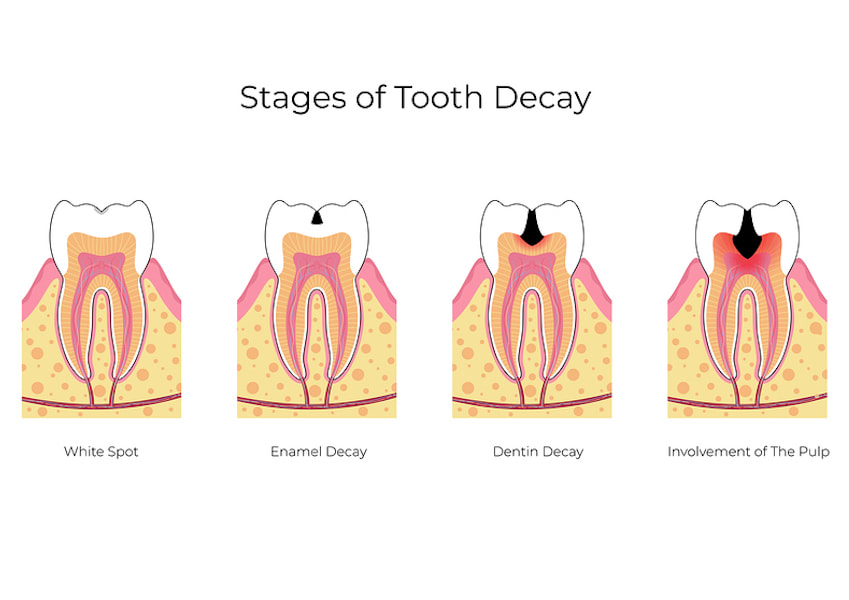 tooth decay