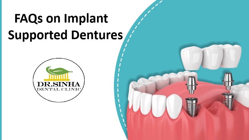FAQs on Implant Supported Dentures