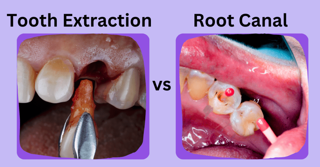 root canal treatment or tooth extraction