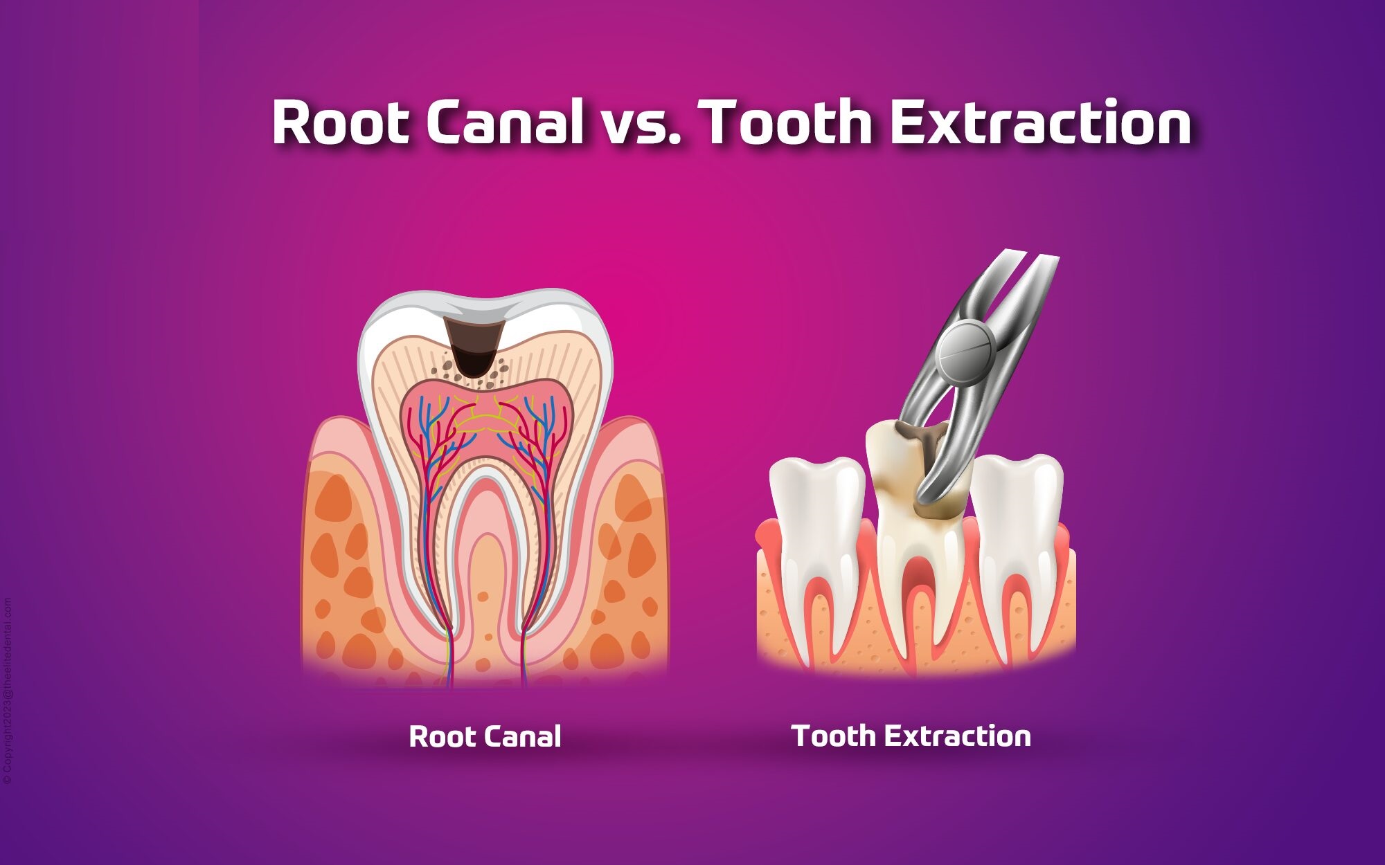 Root Canal Treatment or Tooth Extraction: Which is Better?
