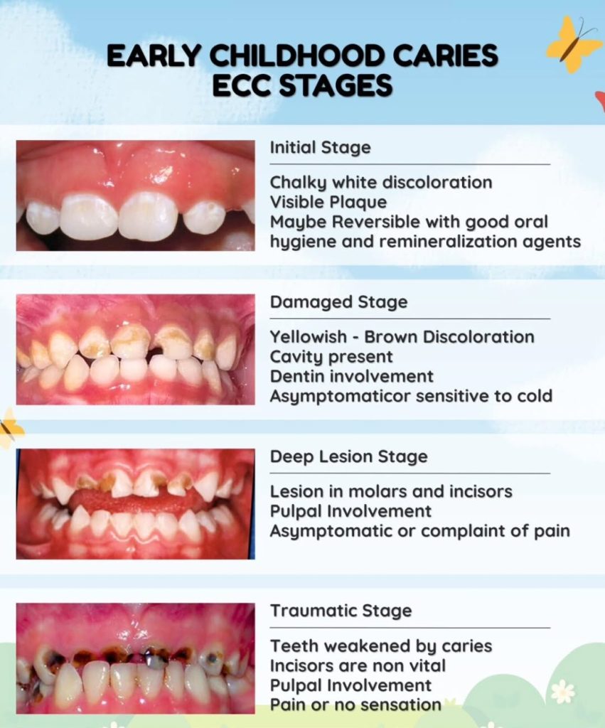 Early Childhood Caries