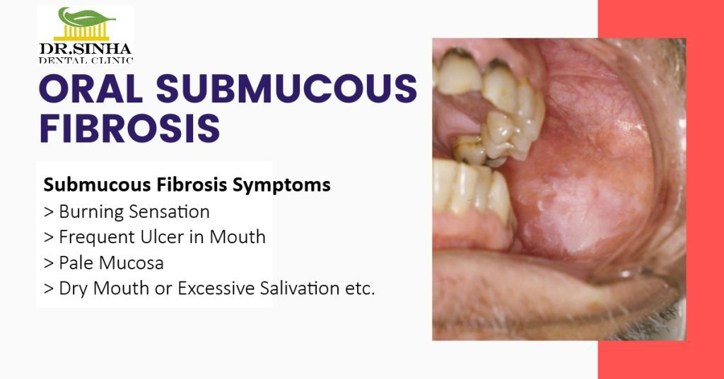 Oral Submucous Fibrosis