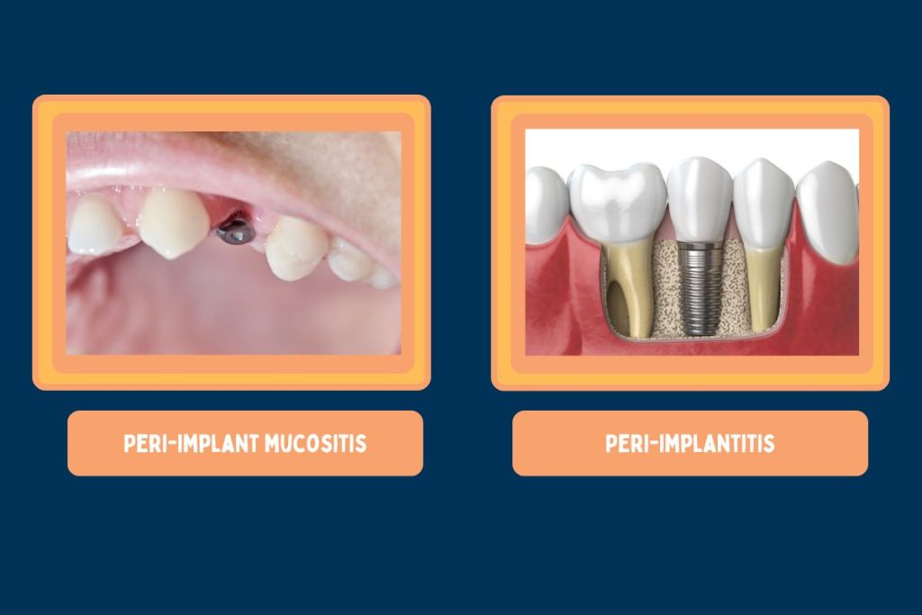 dental implant infection treatment